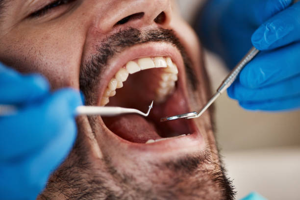 Best Emergency Dentist for Lost Fillings or Crowns in St John, MO